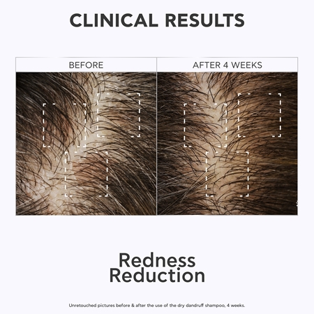 Apivita Dandruff Relief Dry Dandruff Dermatological Shampoo Pretblaugznu šampūns sausai un niezošai galvas ādai