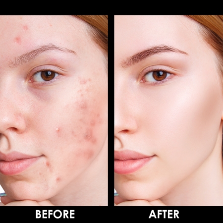 Arval Puractiva Acness cleansing balm