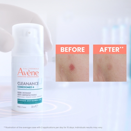 Avène Cleanance Comedomed+ cuidado intensivo para imperfecciones de la piel con acné