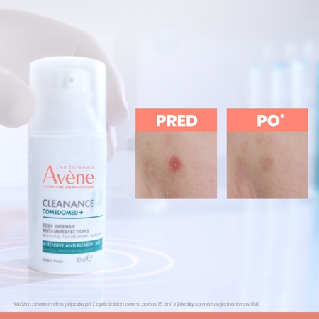 Avène Cleanance Comedomed+ intenzívna starostlivosť proti nedokonalostiam aknóznej pleti