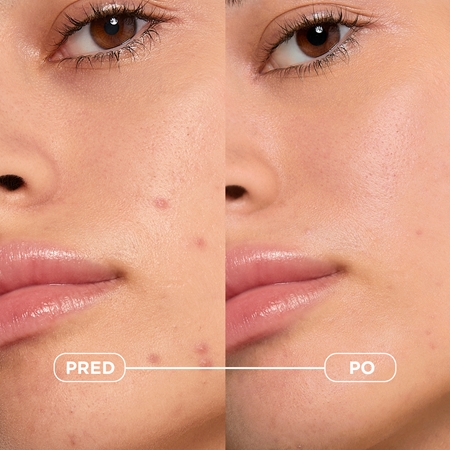 Bioderma Sébium Kerato+ gélový krém proti nedokonalostiam aknóznej pleti