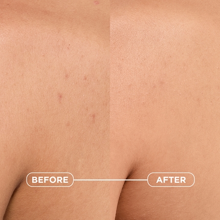 Bioderma Sébium Kerato+ Body Bodyspray gegen Akne, Rötungen und Aknenarben