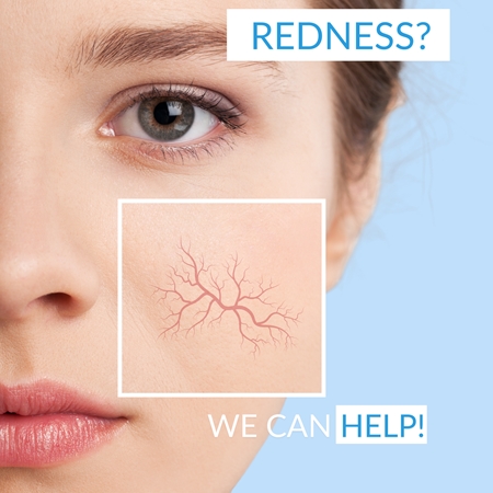 Dermedic Redness Calm espuma de limpeza apaziguador