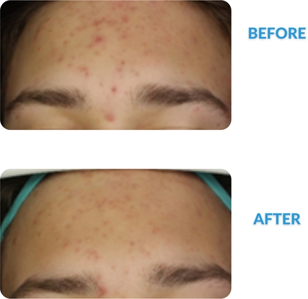 Dermedic Redness Calm crème anti-rougeurs et anti-vaisseaux dilatés