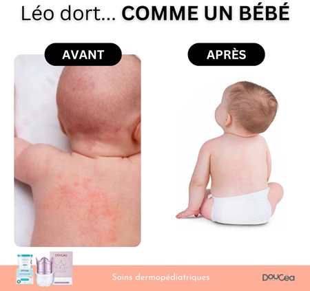 Doucea Doutopia Cream αναγεννητική κρέμα για ατοπική επιδερμίδα για παιδιά και ενήλικες
