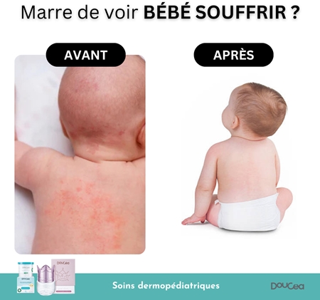 Doucea Doutopia Cream αναγεννητική κρέμα για ατοπική επιδερμίδα για παιδιά και ενήλικες