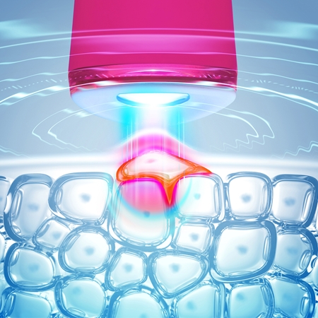 FOREO ESPADA™ 2 aknen oireita lievittävä, sinistä valoa hyödyntävä ihonhoitokynä