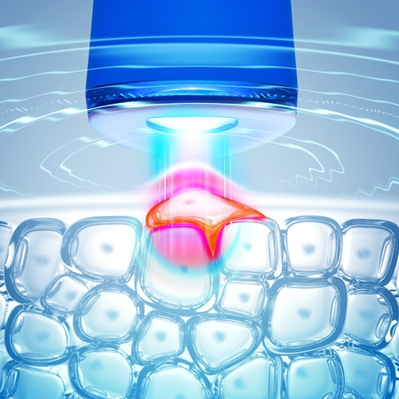 FOREO ESPADA™ 2 aknen oireita lievittävä, sinistä valoa hyödyntävä ihonhoitokynä