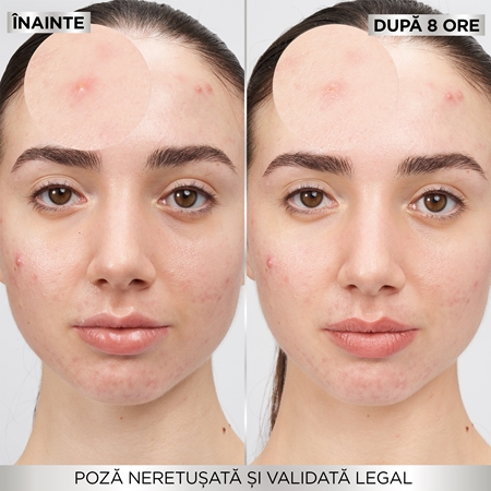 Garnier Pure Active Pimple Patch plasturi pentru piele problematică impotriva acneei