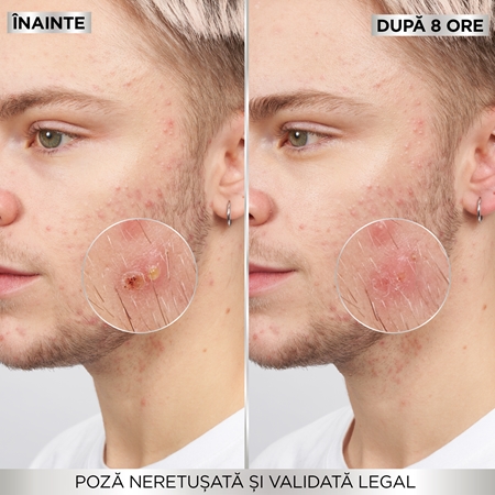 Garnier Pure Active Pimple Patch plasturi pentru piele problematică impotriva acneei