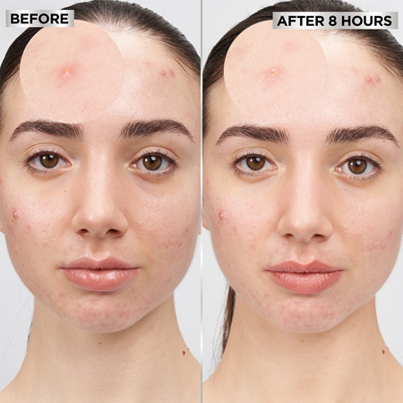 Garnier Pure Active Pimple Patch patchs à peaux à problèmes anti-acné