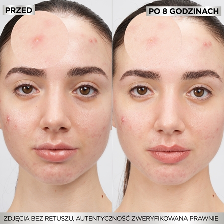 Garnier Pure Active Pimple Patch plastry dla skóry problematycznej przeciw trądzikowi