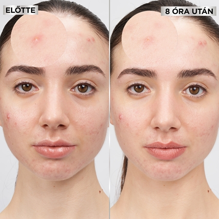 Garnier Pure Active Pimple Patch tapasz problémás bőrre pattanások ellen