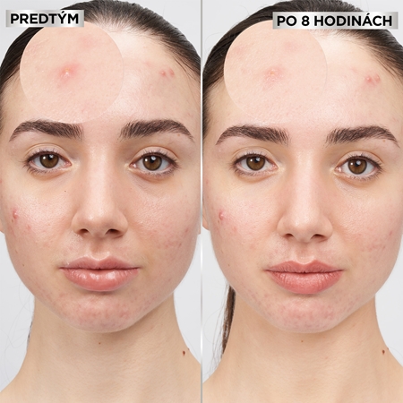 Garnier Pure Active Pimple Patch náplasti na problematickú pleť proti akné
