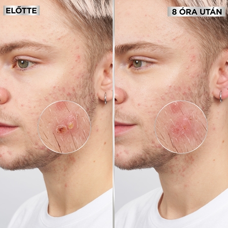 Garnier Pure Active Pimple Patch tapasz problémás bőrre pattanások ellen