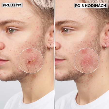 Garnier Pure Active Pimple Patch náplasti na problematickú pleť proti akné