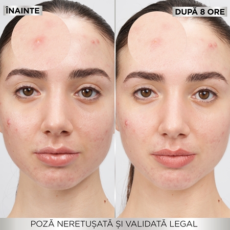 Garnier Pure Active Pimple Patch plasturi pentru piele problematică impotriva acneei
