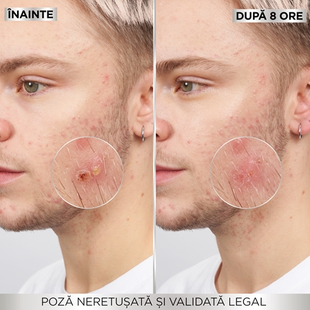 Garnier Pure Active Pimple Patch plasturi pentru piele problematică impotriva acneei