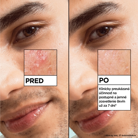 Garnier Salicylic Serum sérum proti nedokonalostiam pleti