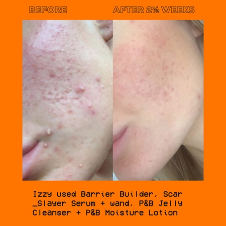 Glow Hub The Scar Slayer Brightening Serum for pigment spot correction