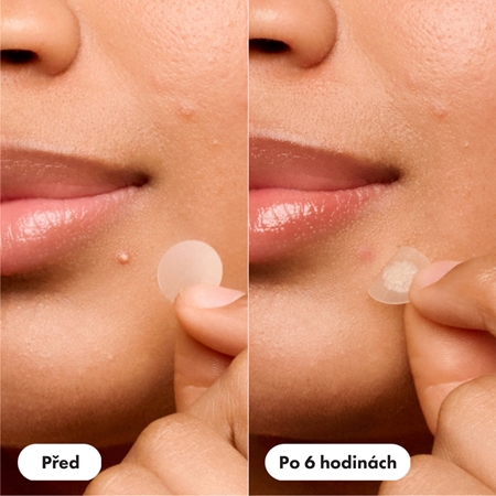 Hero Cosmetics Mighty Patch Original plastre til at behandle akne
