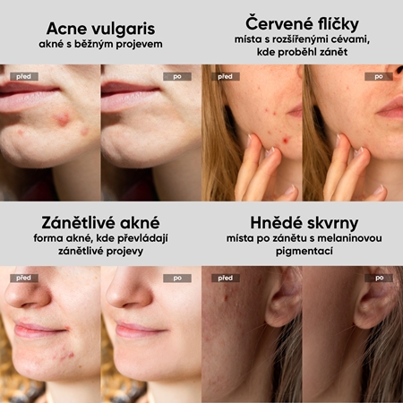 JOVS Acneaway přístroj na léčbu akné