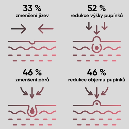 JOVS Acneaway přístroj na léčbu akné