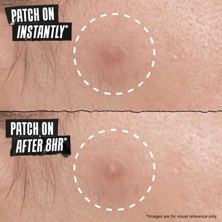 Kiehl's Truly Targeted Overnight Blemish Patch Patches for Problematic Skin