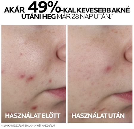 La Roche-Posay Effaclar koncentrált szérum problémás és pattanásos bőrre
