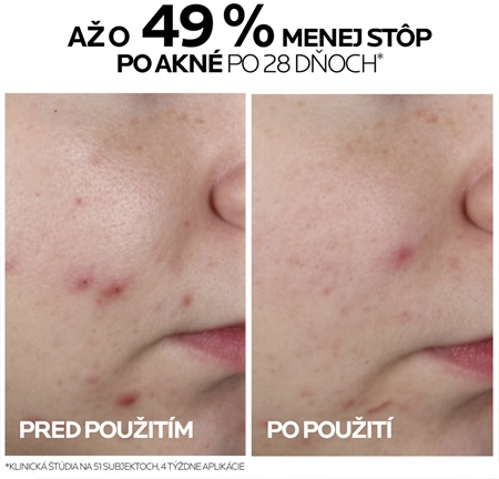 La Roche-Posay Effaclar koncentrované sérum pre problematickú pleť, akné