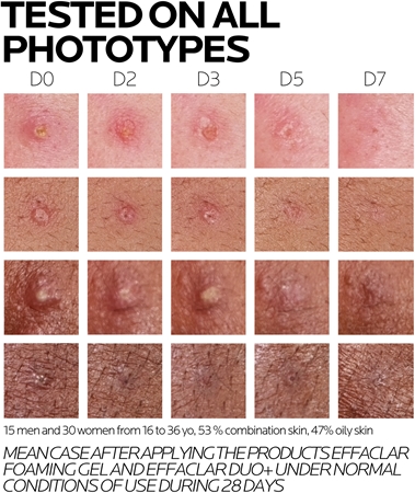 La Roche-Posay Effaclar Σετ για λιπαρή και προβληματική επιδερμίδα