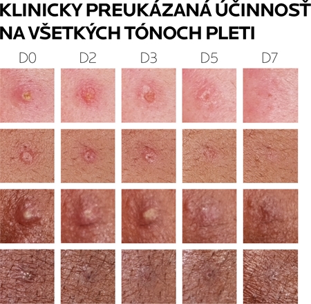 La Roche-Posay Effaclar DUO (+M) korekčná obnovujúca starostlivosť proti nedokonalostiam pleti a stopám po akné