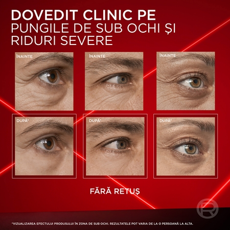 L’Oréal Paris Revitalift Laser tratament pentru ochi umflati