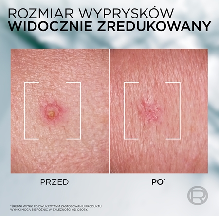 L’Oréal Paris Men Expert Derma Control krem przeciw niedoskonałościom z niacynamidem
