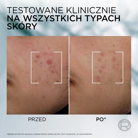 L’Oréal Paris Men Expert Derma Control serum przeciw niedoskonałościom skóry