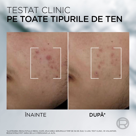 L’Oréal Paris Men Expert Derma Control ser impotriva imperfectiunilor pielii