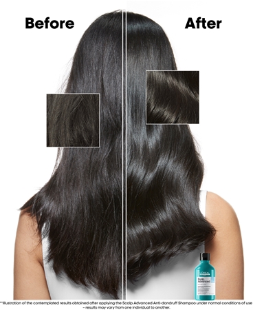 L’Oréal Professionnel Serie Expert Scalp Advanced champô anticaspa