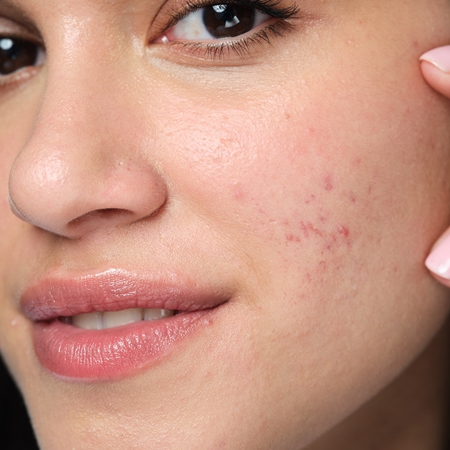 Neutrogena Clear & Defend+ peeling químico