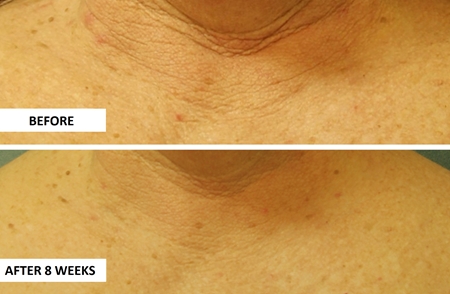 Perricone MD Cold Plasma Plus+ Neck & Chest SPF 25 Opstrammende creme til hals og kavalergang SPF 25