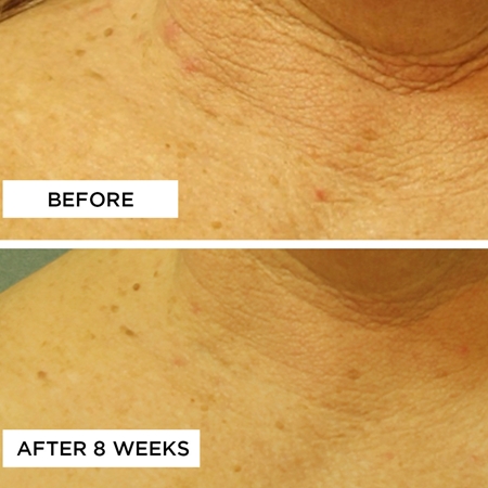 Perricone MD Cold Plasma Plus+ Neck & Chest SPF 25 Opstrammende creme til hals og kavalergang SPF 25
