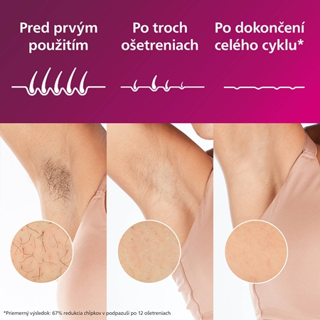Philips Lumea IPL 7000 SC1994/00 epilátor na telo a nohy