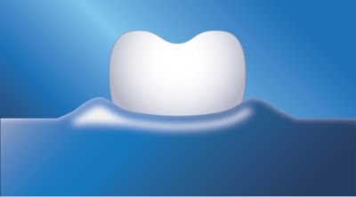 Philips Sonicare AirFloss Ultra Interdental-Düsen