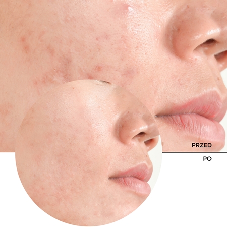 Revox B77 JUST Salicylic Acid 2% serum peelingujące o działaniu złuszczającym do twarzy