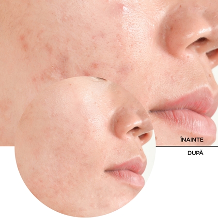 Revox B77 JUST Salicylic Acid 2% serum cu efect exfoliant faciale
