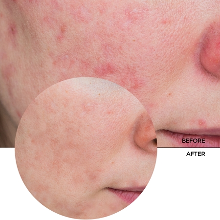 Revox B77 Just Azelaic Acid 10% posvjetljujuća emulzija za lice