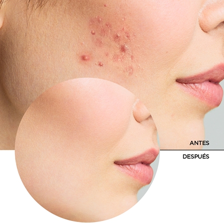 Revox B77 Zitcare AHA BHA PHA Active Face Toner tónico limpiador suave