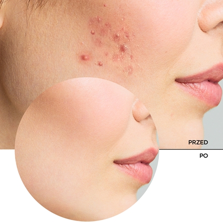 Revox B77 Zitcare AHA BHA PHA Active Face Toner delikatny tonik oczyszczający