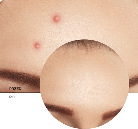 Revox B77 Zitcare AHA BHA PHA Spot Treatment antytrądzikowa pielęgnacja punktowa