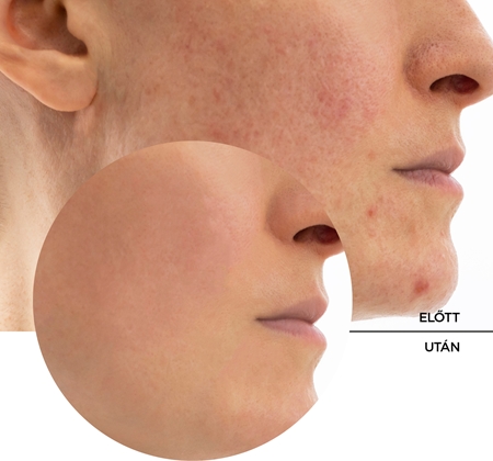 Revox B77 Skintreats Biotic Rebalancing Smoothing Gel gyengéd géles krém a sima és matt arcbőrért