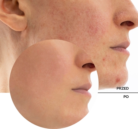 Revox B77 Skintreats Biotic Rebalancing Smoothing Gel lekki krem-żel dla wygładzonej i zmatowionej cery